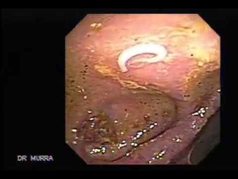 Untreated giardia