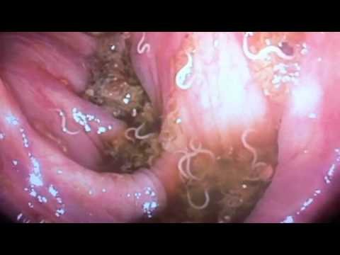 Hogyan jelennek meg a pinworms