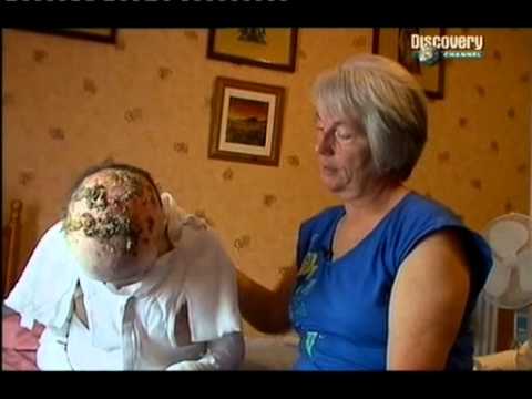 A teniózis elterjedt a világon