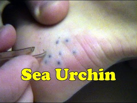 Pinworms újjel