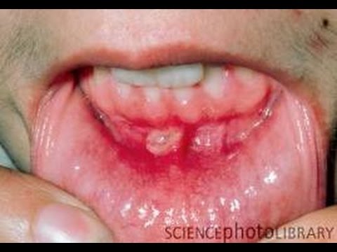 Nem a teniasis megelőzésének egyik módja