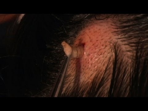 Parazitakezelés a 4. módszer szerint A pinworms származik