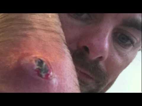 Aszcariasis klinikai kép