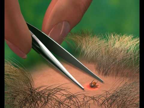 Az emberi test parazitáinak megelőzése népi gyógyszerekkel Férgek emberi parazitákból