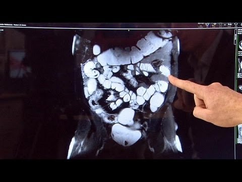 Gyermekek kezelése férgek férfiak áttekintése alapján Otthoni parazitaellenes gyógyszerek