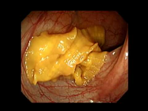 Chronic giardia forum