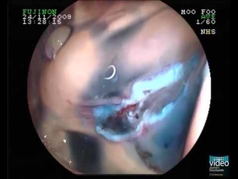 Ascaris 2 éves gyermeknél