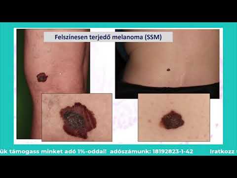 Biorezonancia terápia parazitakezelési áttekintések Honnan származnak férgek és hogyan kell kezelni