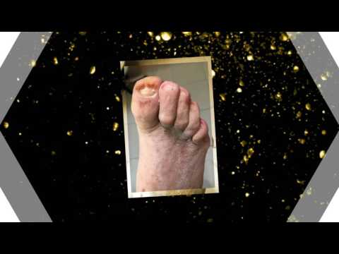 Gyógyszer minden féreg ellen Trichocephalosis gyermekeknél